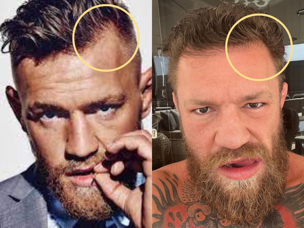 Did Conor McGregor Get a Hair Transplant? Full Story and Photo Evidence