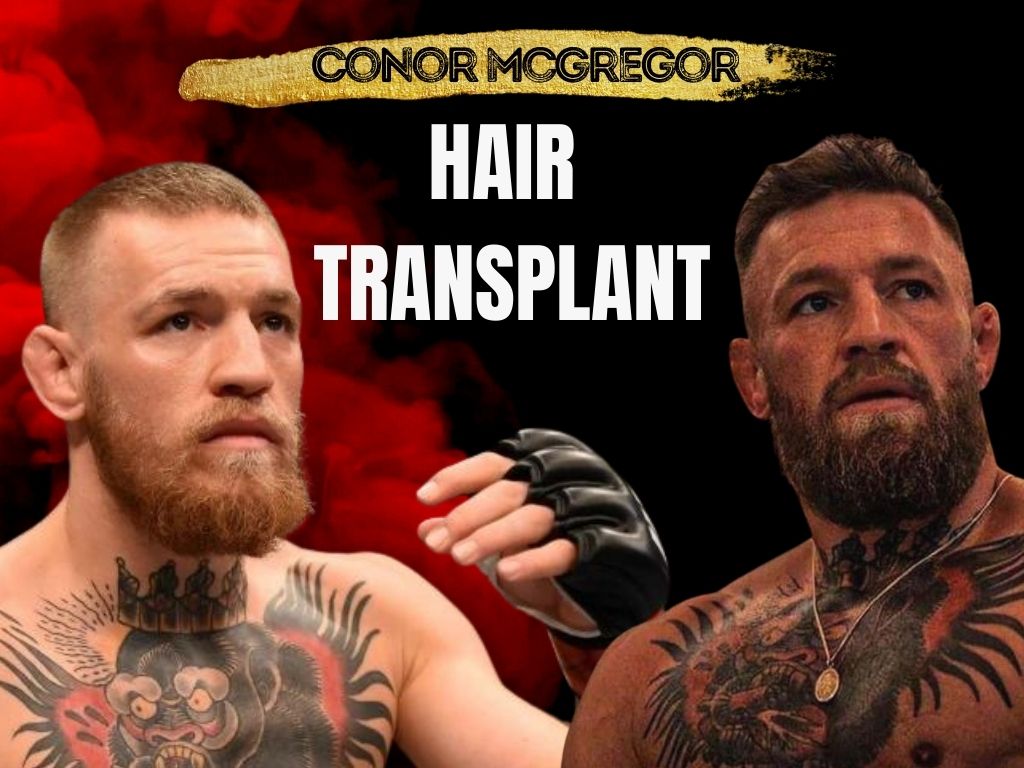 Did Conor McGregor Get a Hair Transplant? Full Story and Photo Evidence