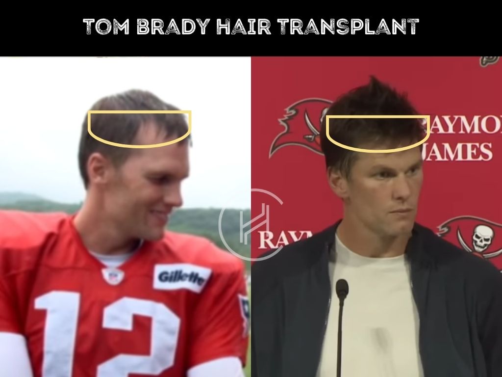 Tom Bradys Hair: Implants or Natural? Exploring the Rumors