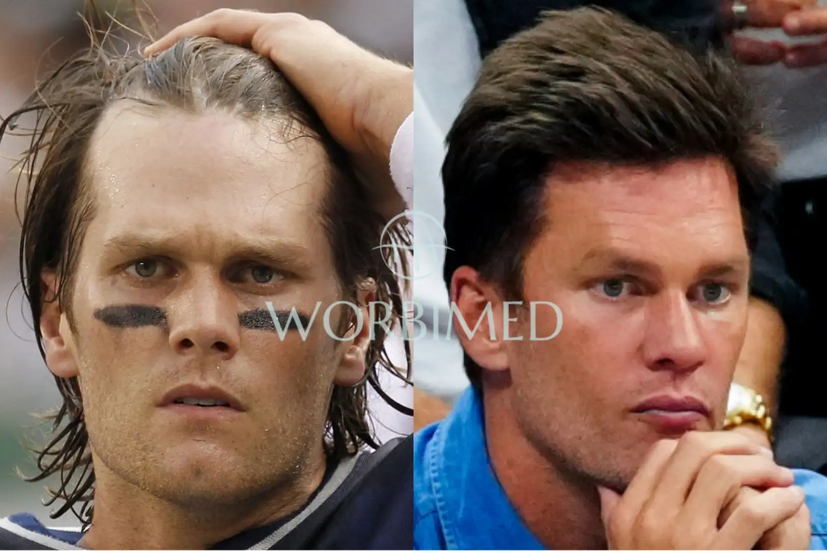 Tom Bradys Hair: Implants or Natural? Exploring the Rumors