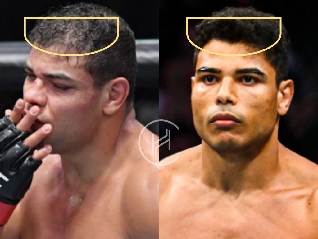 Paulo Costa Hair Transplant: Did He Really Get One?