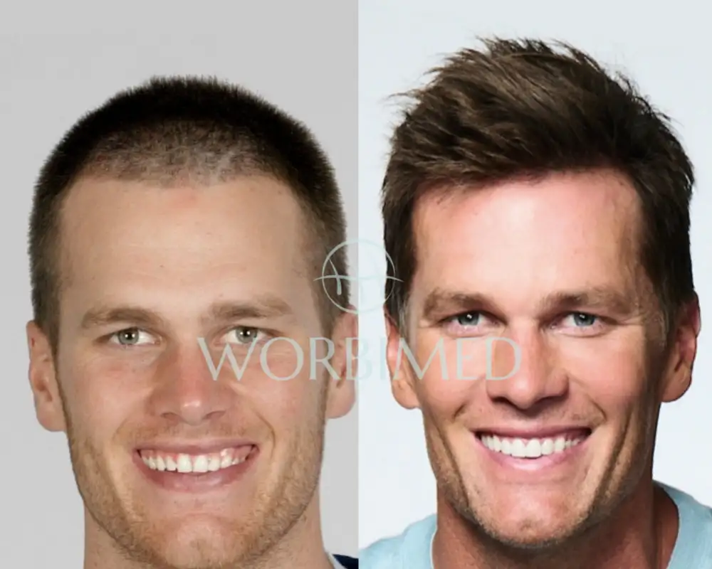 Does Tom Brady Have Fake Hair? Heres What People Are Saying About It!