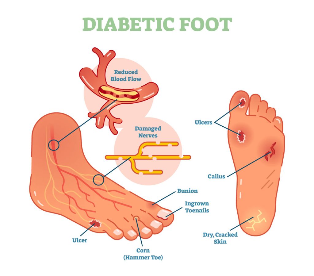 Deion Sanders Toes Surgery: Whats the Diabetes Link?