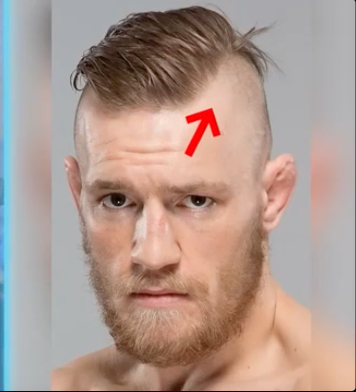 Mcgregor Hairline: Fans Ask, Is He Losing His Hair?